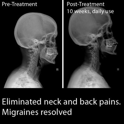 NEW: Large Cervigard™ Forward Head Posture Neck Collar with bifurcated fulcrum